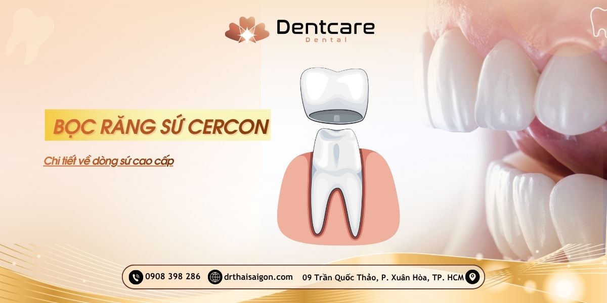 Bọc răng sứ Cercon: Chi tiết dành cho người am hiểu về dòng sứ cao cấp