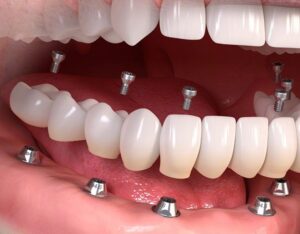 Trồng răng Implant cho người lớn tuổi – Giải pháp toàn diện cho nụ cười tuổi già