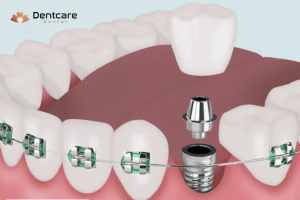 Có Thể Niềng Răng Sau Khi Trồng Răng Implant Không?
